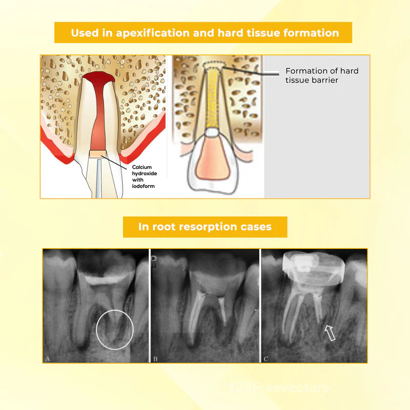 Waldent RCT pex Root Canal Filling Material (Radiopaque)